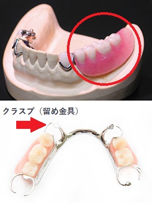 部分入れ歯について | 久我山駅前歯科・矯正歯科