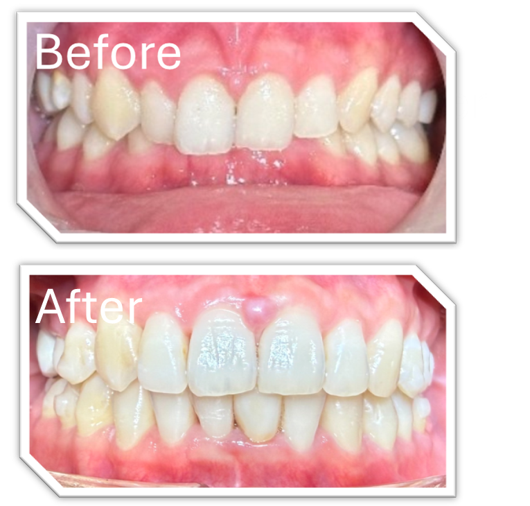 前歯部の重度虫歯を、当日で審美修復したケース🦷✨ | 症例一覧 | 東京