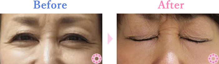 シワ取り（ボトックス）｜ボトックス｜美容整形のことなら東京形成美容