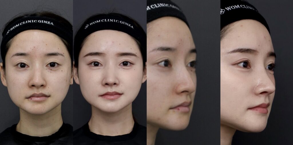 中顔面の立体感を整え、口元の突出感まで改善した初回鼻整形No.1402