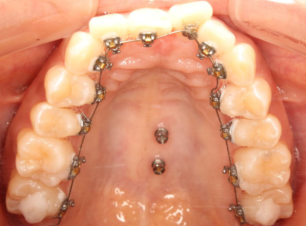 成人矯正｜立川の矯正歯科・小児矯正｜新井矯正歯科