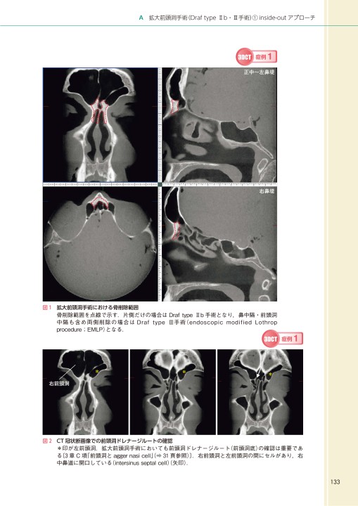 内視鏡下鼻副鼻腔・頭蓋底手術_CT読影と基本手技2e_立読み