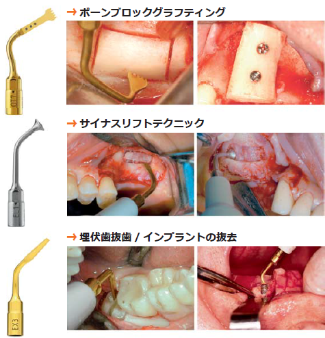 ピエゾサージェリー タッチ ベーシック1｜株式会社インプラテックスの