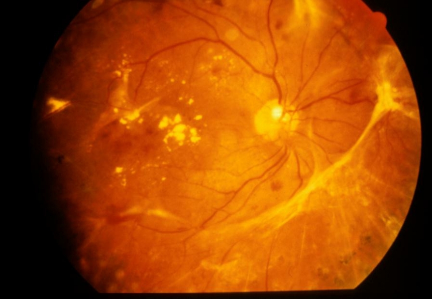 糖尿病網膜症の検査・治療法｜枚方市の南眼科 香里ヶ丘中央クリニック