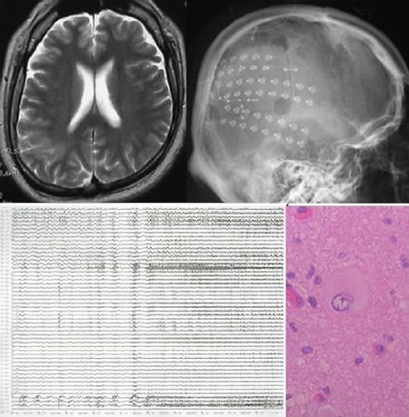 和歌山医大脳神経外科