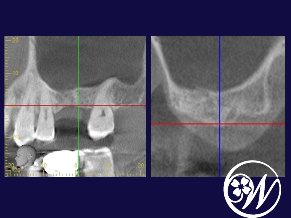 症例】低侵襲、短期間で終わる上顎洞底挙上術で大規模な骨造成を回避