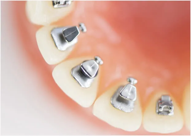 見えない裏側舌側矯正｜大阪府枚方市の辻村矯正歯科