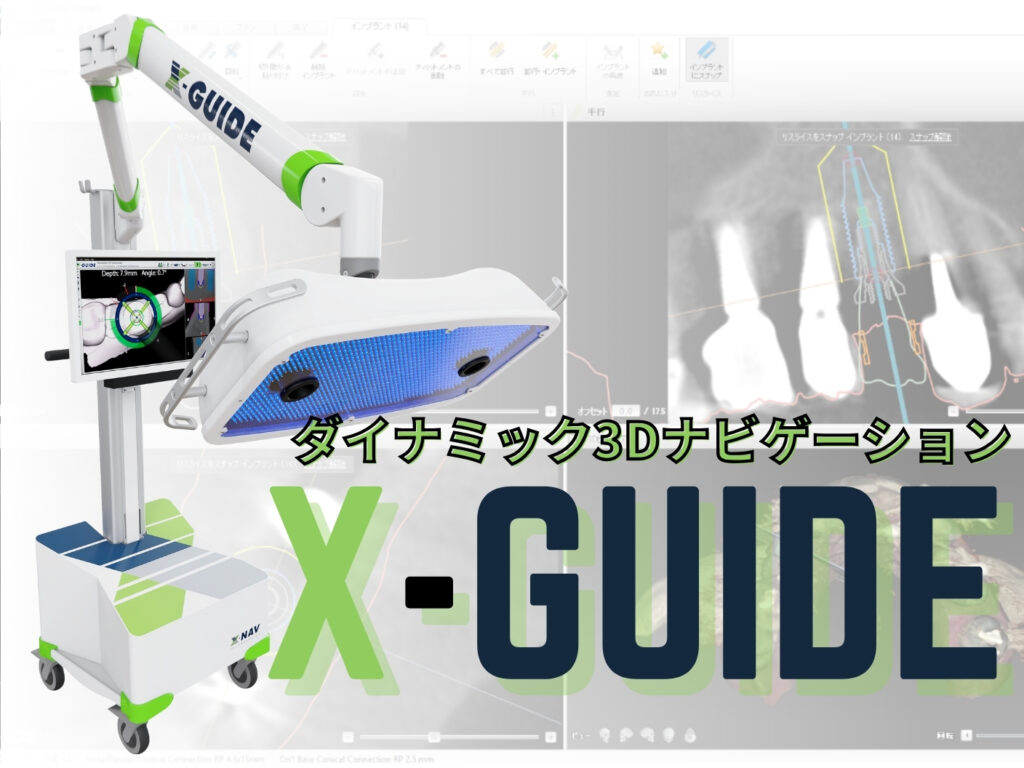 X-guideを活用したインプラント手術