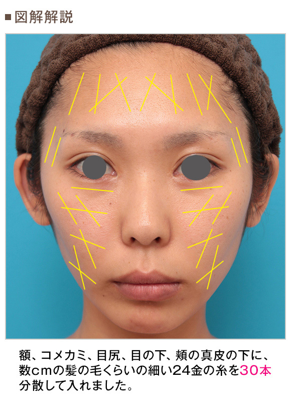 TAKASU GOLDEN LIFT 高須クリニック ゴールデンリフト 美容液