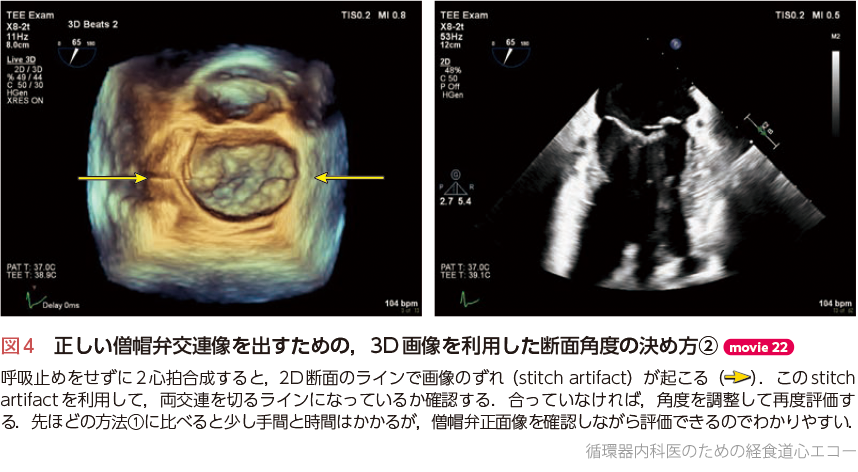 循環器内科医のための経食道心エコー〜基本的な手技から術中・術前の