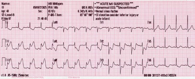 Myocardial Infarction and Acute Coronary Syndromes (ACS