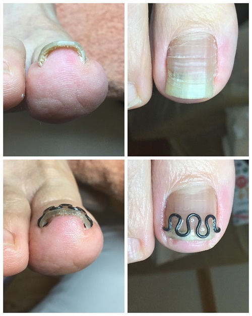 再発した巻き爪】B/Sスパンゲで矯正していました。