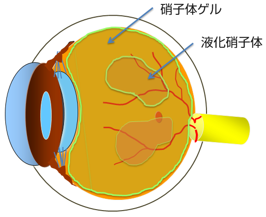 網膜の外科的治療（手術）について | 【高松e眼科】Day Surgery 高松の