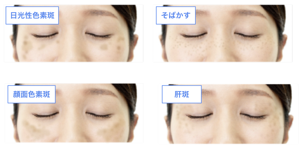 業務用シミ取り】シミクライオポレーション｜特徴やマシン価格