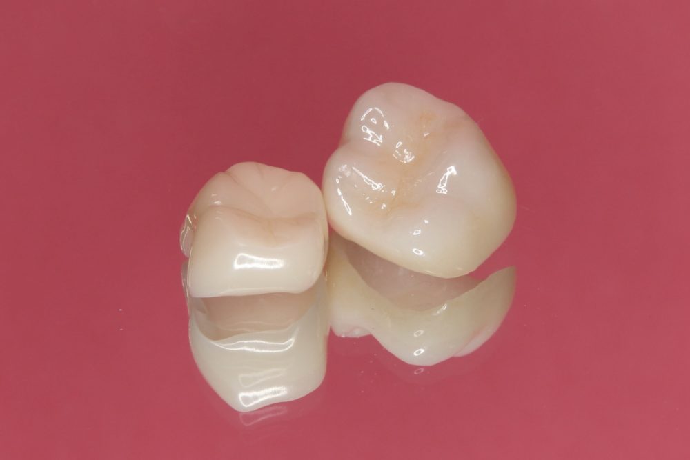 憧れのオールセラミックが身近に。知りたい！CAD/CAMクラウン』 | 医療