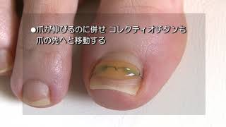 巻き爪矯正器具【コレクティオパーフェクト】医療機関の方へ | 株式