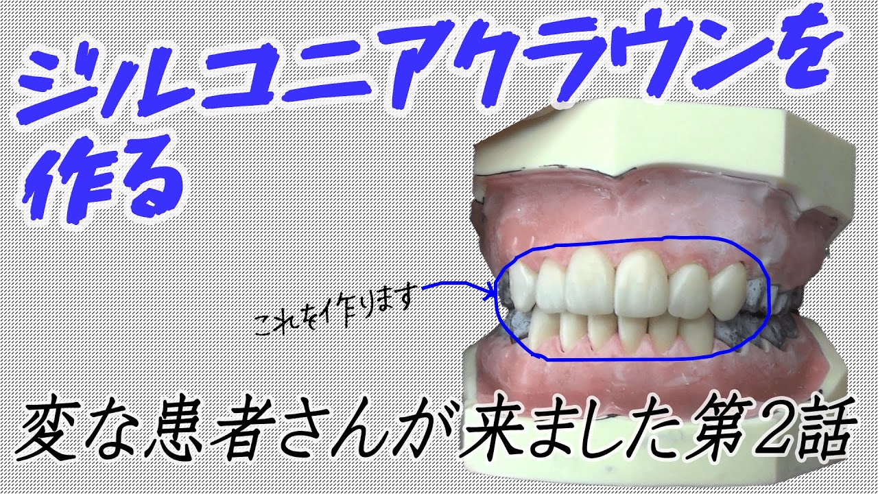 歯科技工】ジルコニアクラウンの作り方を解説する！変な患者が来ました