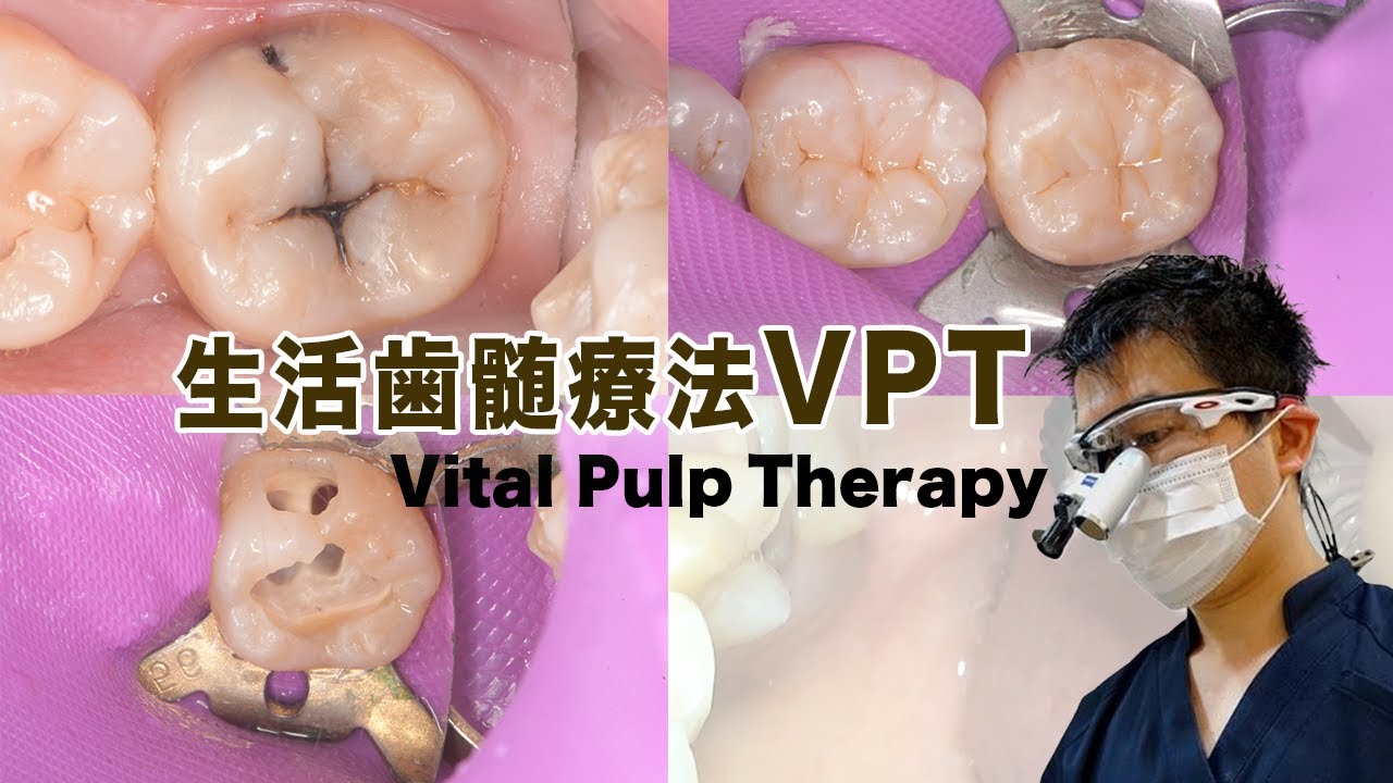 VPT【歯髄温存療法】Vital Pulp Therapy - YouTube