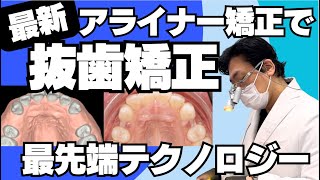 最新アライナー矯正で抜歯矯正治療ができる理由！解説します - YouTube