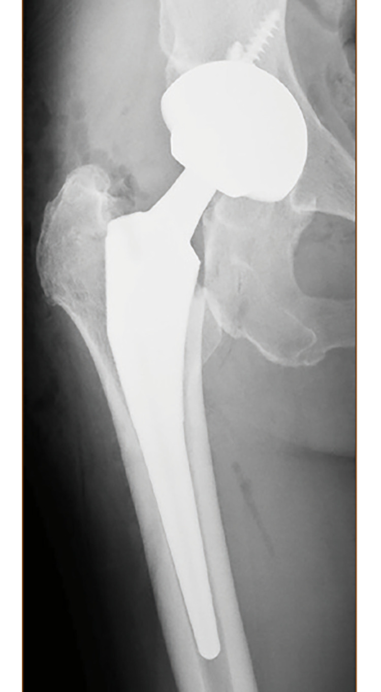 高齢者の大腿骨近位部骨折（頚部骨折・転子部骨折）に対する早期手術の