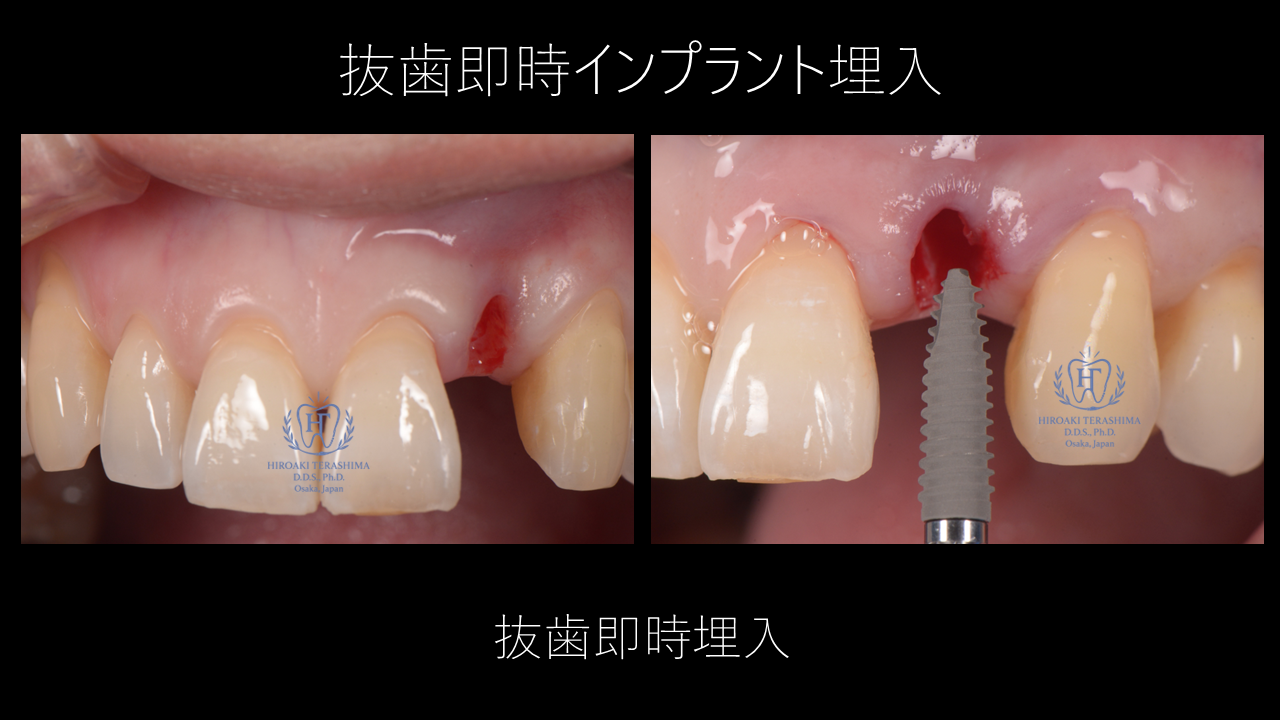 前歯のインプラント治療 〜重度歯周炎による歯肉と骨の喪失