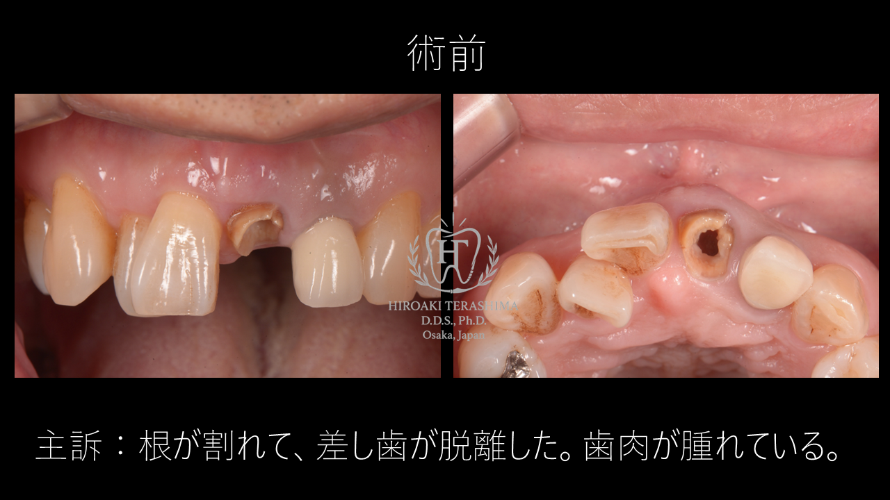 前歯が折れた場合の治療法｜抜歯即時インプラントによる審美回復症例