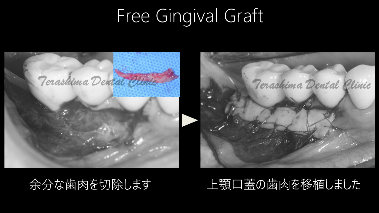 歯肉の移植術~遊離歯肉移植術~インプラント | 箕面市の歯医者【寺嶋