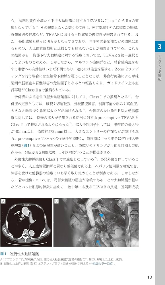 ステントグラフト内挿術マニュアル 胸部編 ─ 動画を含む電子版付