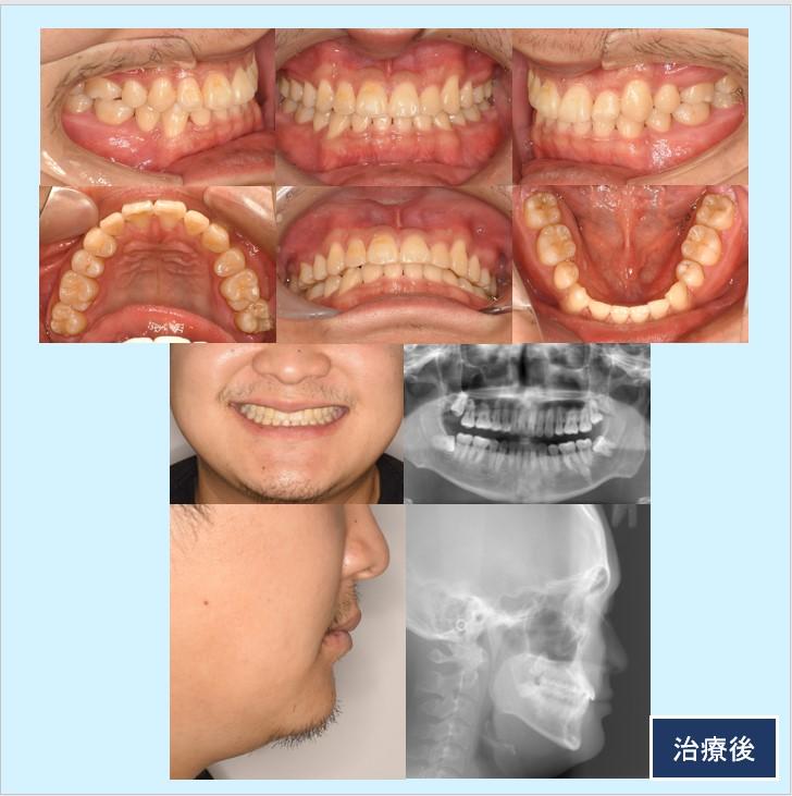 No.33 外科矯正をせずに矯正治療のみで反対咬合を改善した症例 | 見え