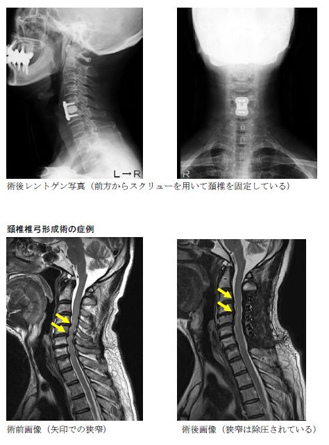 脊椎・脊髄 - 脊椎変性疾患