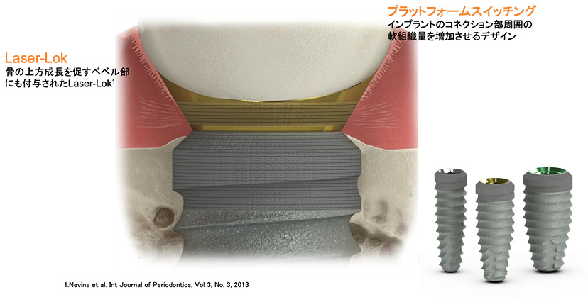 当院のインプラントシステム - 郡山でインプラントなら宝沢伊藤歯科医院
