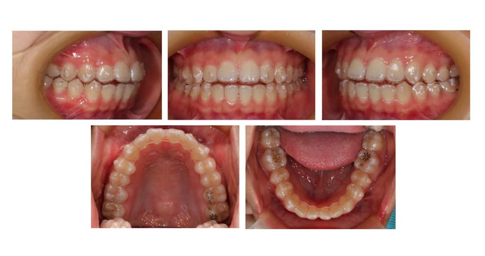 マウスピース型矯正装置（インビザライン） | 佐賀駅前矯正歯科